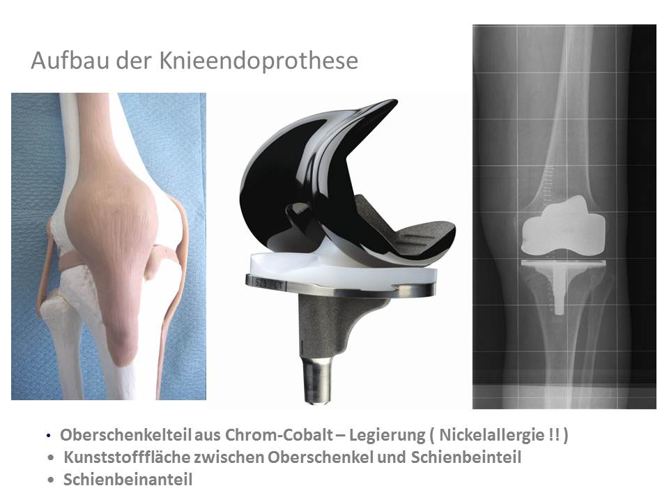 Aufbau der Knieprothese 