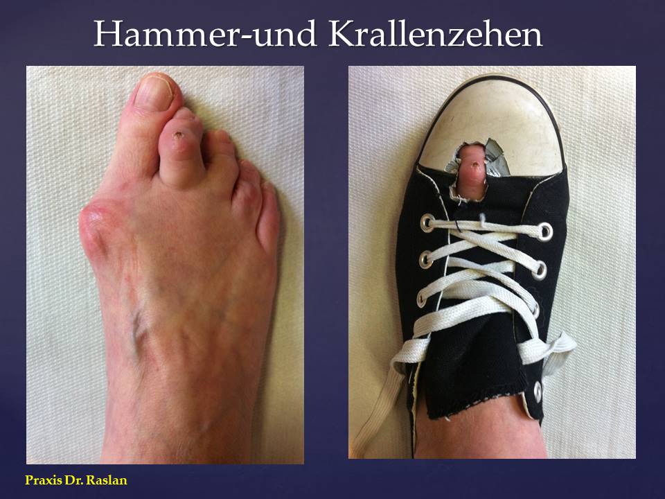 Fußspezialist Dr Raslan Berlin Hammer und Krallenzehen