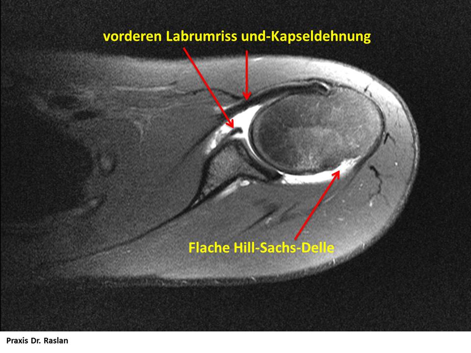 Orthopäde Berlin Dr Schulterluxation Dr Raslan Schulterspezialist Berlin 01